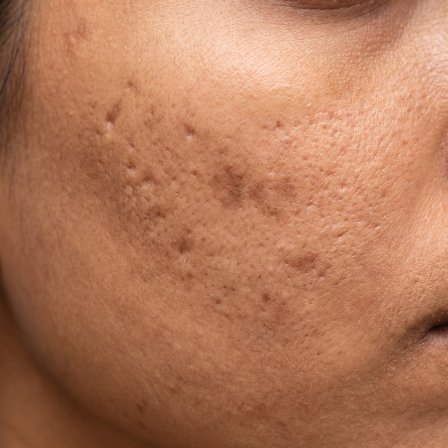 Acne scars — AI-generated clinical illustration, not a photograph of a patient