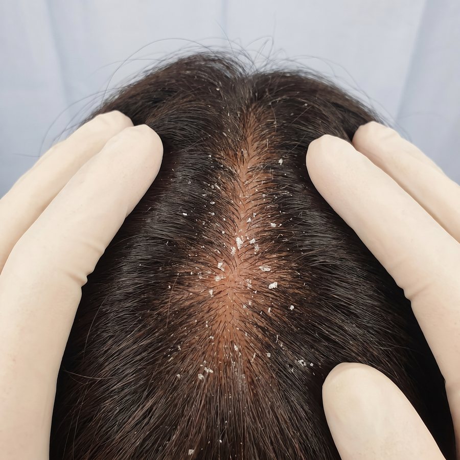 Dandruff — AI-generated clinical illustration, not a photograph of a patient