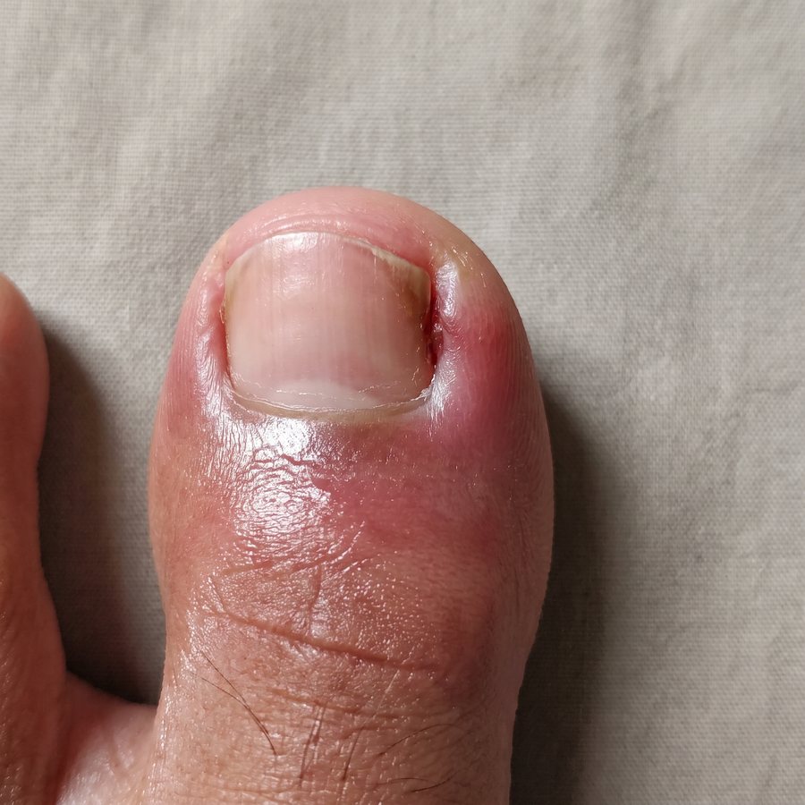 Ingrown nail — AI-generated clinical illustration, not a photograph of a patient