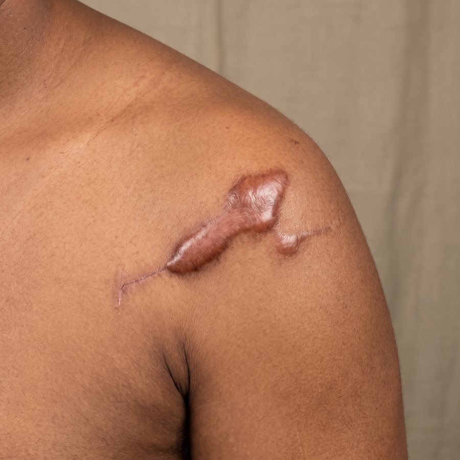 Keloid — AI-generated clinical illustration, not a photograph of a patient