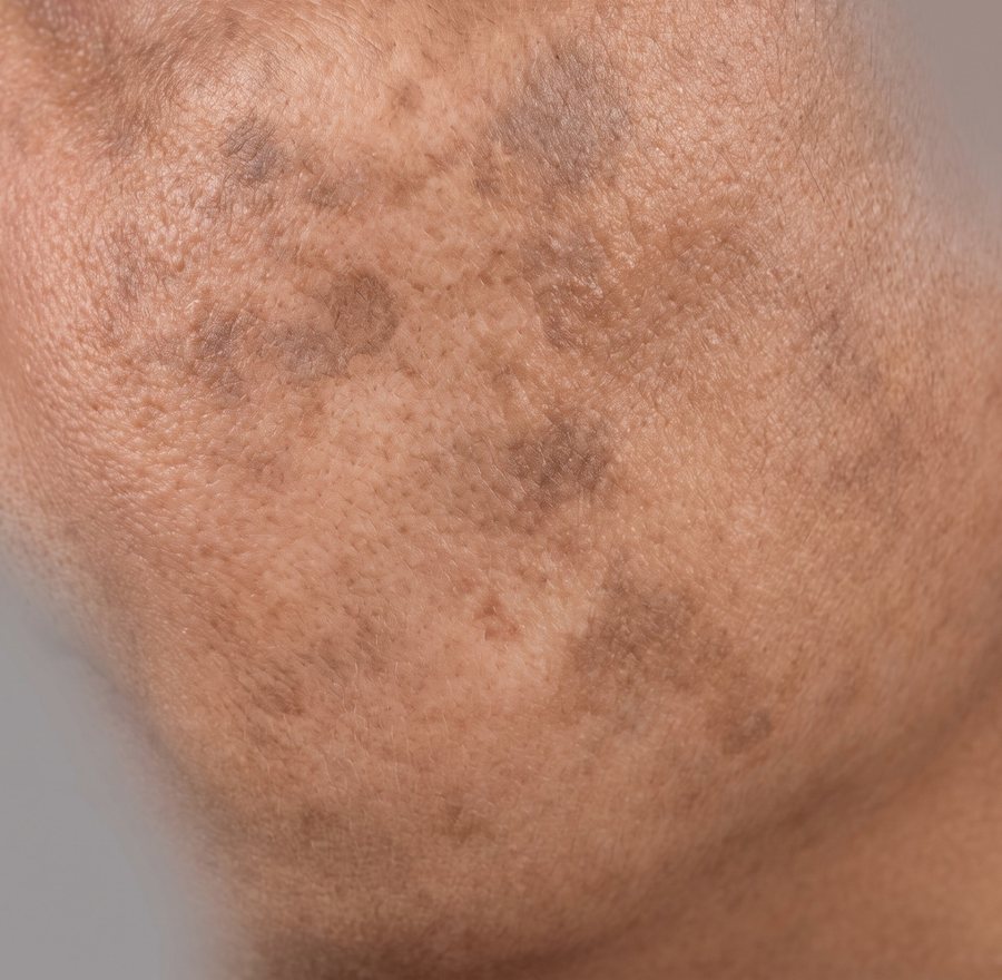 Melasma — AI-generated clinical illustration, not a photograph of a patient