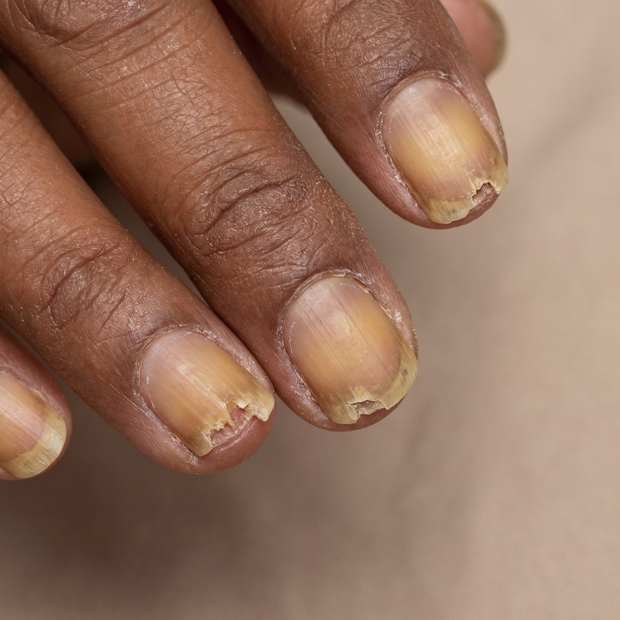 Nail infection — AI-generated clinical illustration, not a photograph of a patient