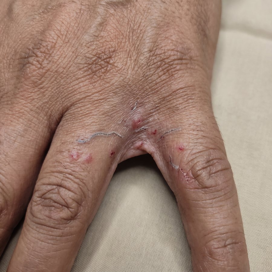 Scabies — AI-generated clinical illustration, not a photograph of a patient