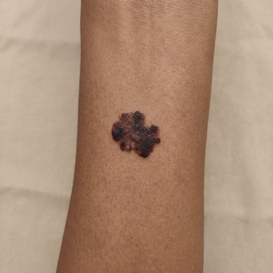 Mole that needs checking — AI-generated clinical illustration, not a photograph of a patient