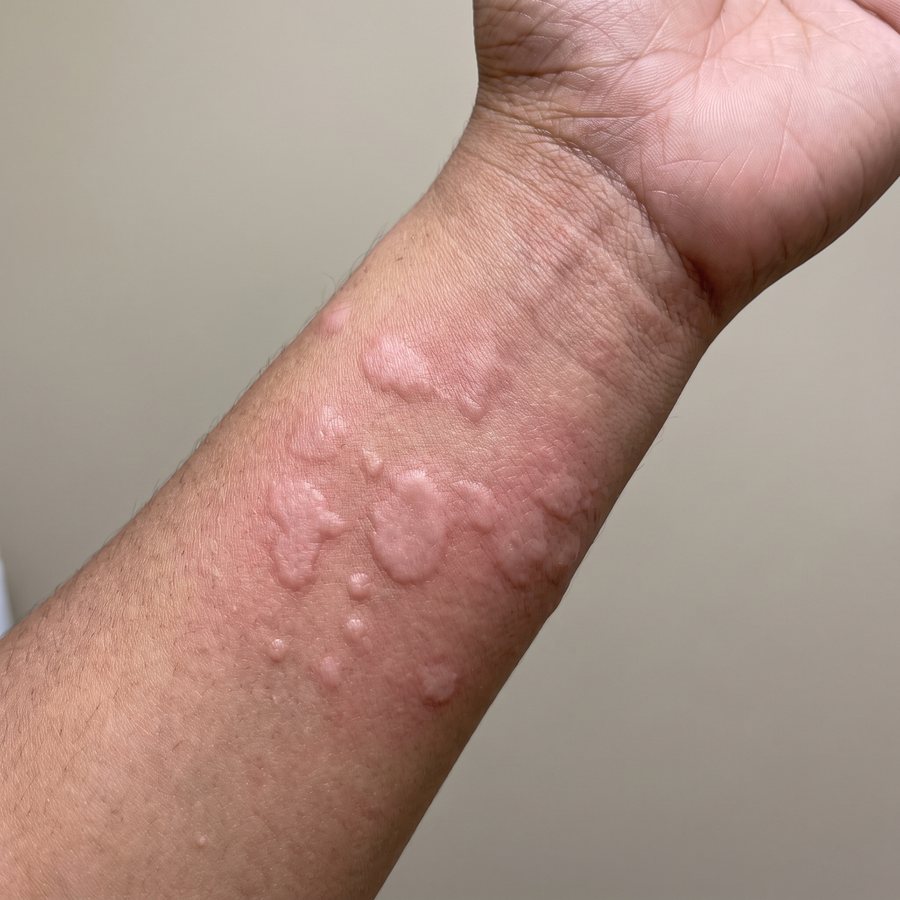 Hives / allergy — AI-generated clinical illustration, not a photograph of a patient