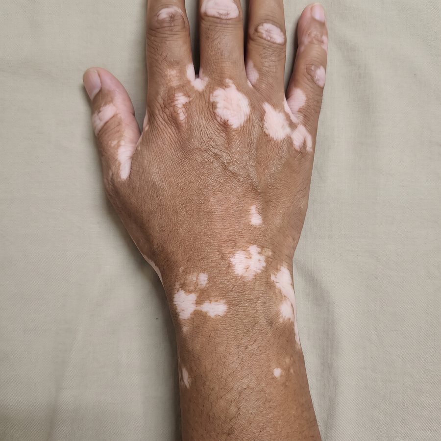 Vitiligo — AI-generated clinical illustration, not a photograph of a patient