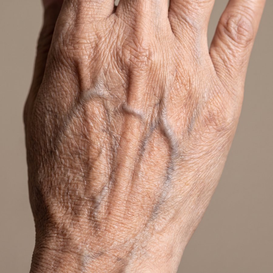 Wrinkles — AI-generated clinical illustration, not a photograph of a patient
